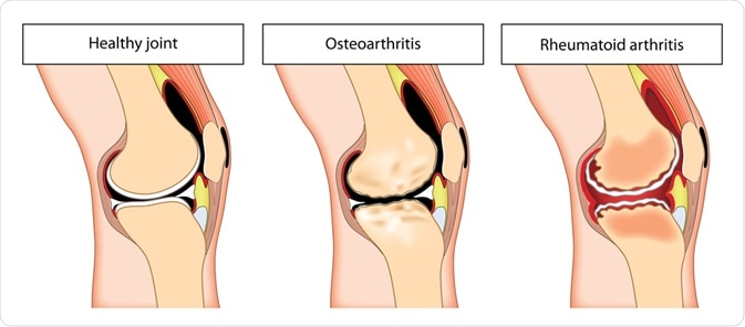  Arthritis